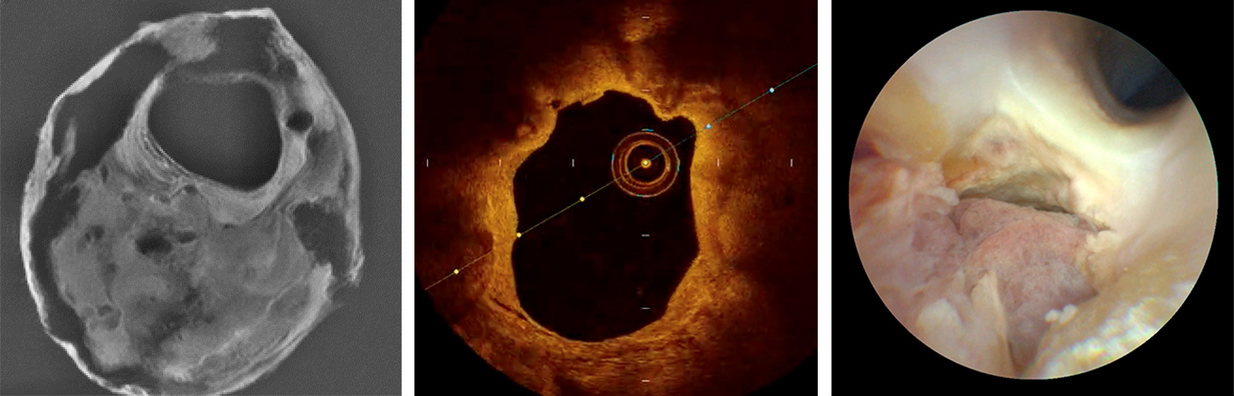 Three panels showing multimodal images of carotid arteries.