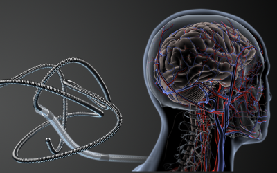 Illustration featuring a catheter and an anatomical representation of the human cerebrovascular system.