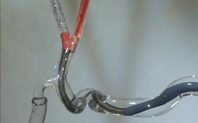 Glass model closeup showing catheters removing clot